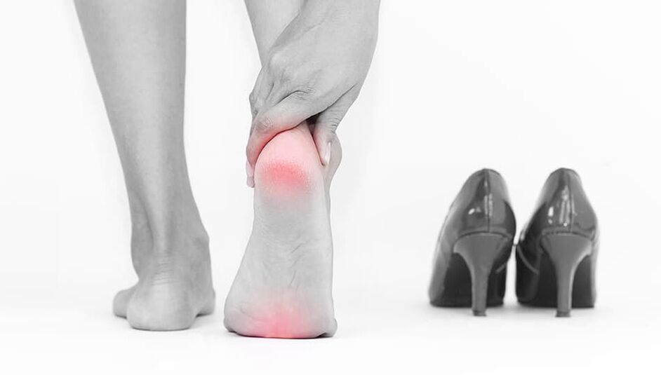 a causa das varizes são sapatos desconfortáveis