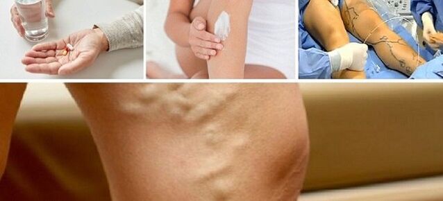 Tratamento de varizes