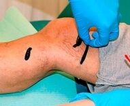 Sanguessugas para varizes