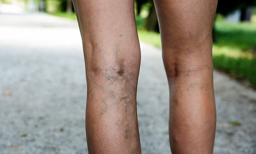 Veias expandidas nas pernas