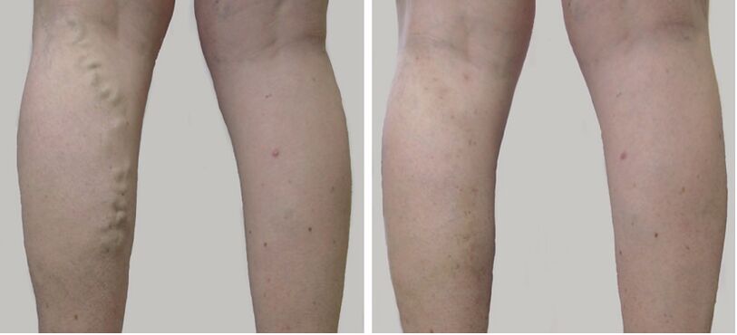 Antes e depois do tratamento