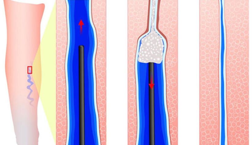 Introdução do esclerosante em escleroterapia