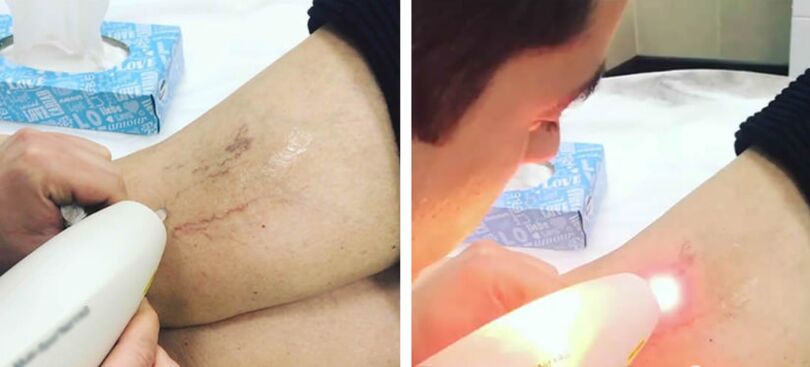 Tratamento a laser