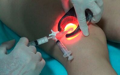 Escleroterapia como uma maneira de tratar varizes nas pernas
